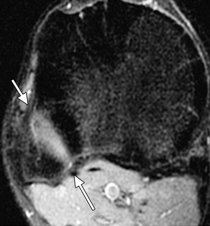, nterosuperior and posterosuperior tibiofibular ligaments are shown (arrows), which strengthen fibrous capsule