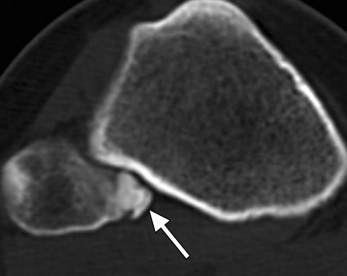 4 Fibular head osteochondroma in 27-year-old woman with lateral knee swelling for 5 months.