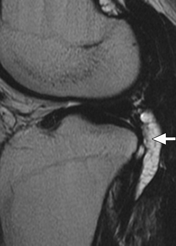 secondary to avulsion of arcuate complex.