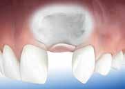 Bone Grafting Sometimes people do not have enough bone to secure the implant into. In these cases we need to carry out additional procedures to augment the bony ridge.