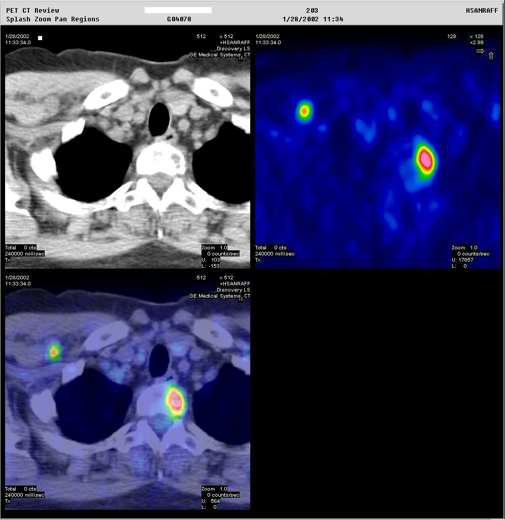 Integrated PET/CT systems Once reconstructed, the CT and PET images are spatially co-registered, allowing the physicians to fuse both the