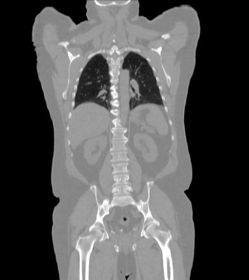 Integrated PET/CT systems CT images are also used for the