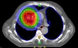 PET/CT TOMOTHERAPY TREATMENT