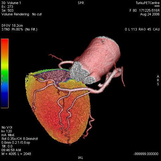 Cardiological Application of PET/CT Case SM O 15