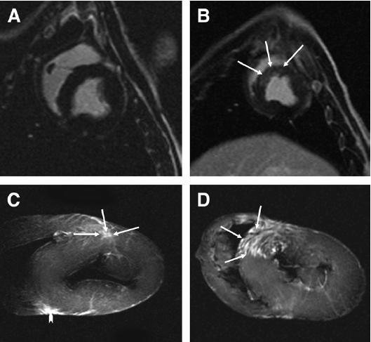 LGE After Coronary Microembolization: Poor Sensitivity of MRI for Detection of Small MIs In Vivo LGE IR-FLASH sequence