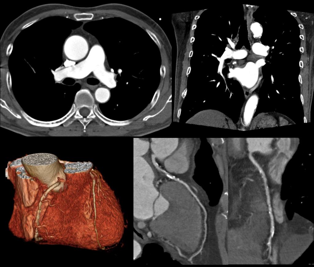 Fig. 4: A case of group 1B underwent TRO-CT with multisegment reconstruction method. A 88-year-old man with rapid, irregular heart beats (86-92 bpm).