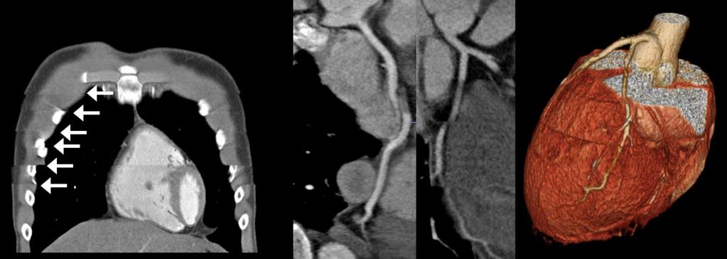 The chest CTA showed stair-step artifact (arrow in a) between the two volume scans, but the image quality of coronary CTA