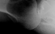 Xrays» hardware» osseous defects Know why it failed Be prepared to open Ease of
