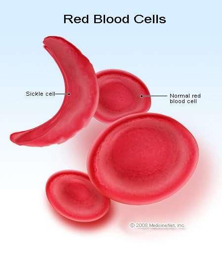 Heterozygote Advantage A well-studied case is that of sickle cell anemia in humans, a hereditary disease that damages red blood cells.