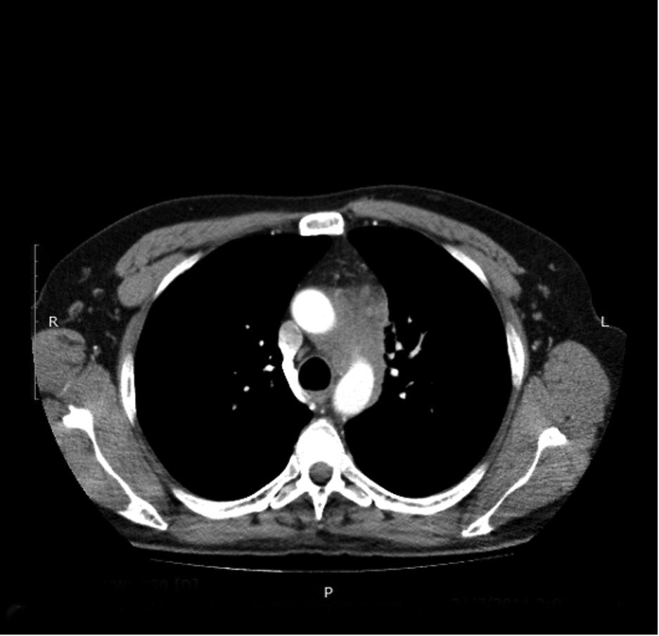 [ Pulmonary, Critical Care, and Sleep Pearls ] A 44-Year-Old Man With Chronic Cough, Weakness, and a Mediastinum Mass Dimitrios Theofilos, MD ; Christina Triantafillidou, MD, PhD ; Athanasios Zetos,