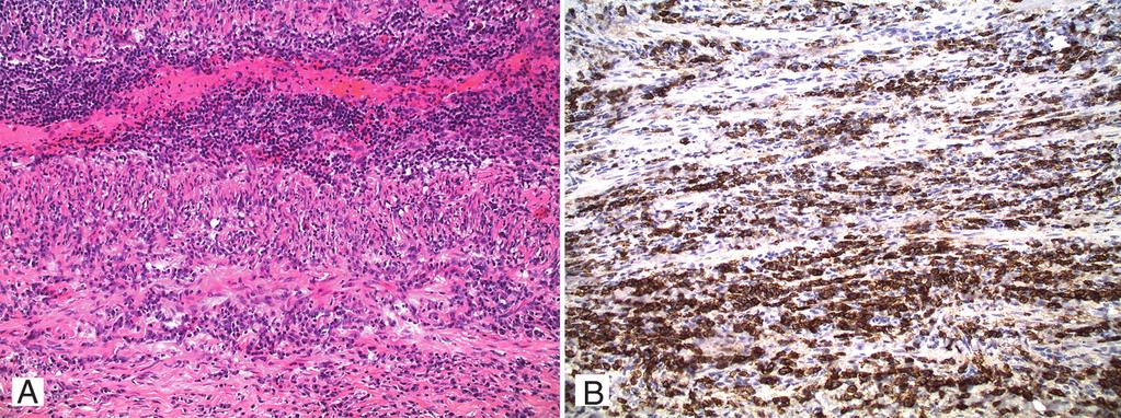 Figure 2 A, Mediastinal mass section obtained by thoracic surgery showing a storiform pattern of fibrosis and intense tissue infiltration by nonspecific-type inflammatory cells.