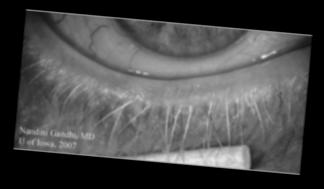Ocular Rosacea Symptoms
