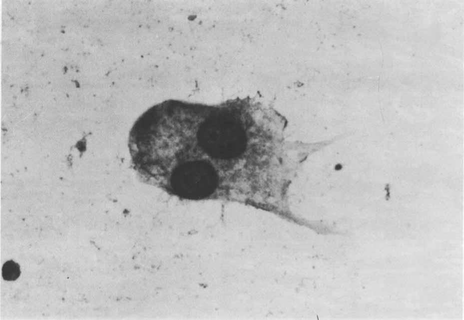 182 CANCER July 1 1980 Vol. 46 FIG. 4. Smear from high-grade chondrosarcoma. Binucleate tumor cell containing no alkaline phosphatase.