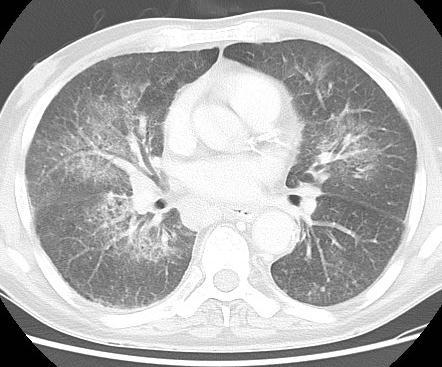 Radiologic Features of Pulmonary