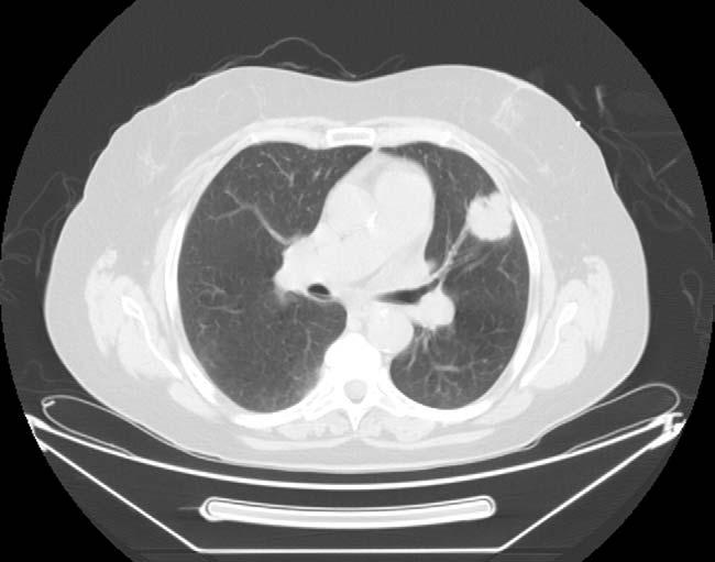 The purpose of this investigation was to evaluate the patterns of recurrence, postoperative morbidity differences, and survival differences between patients with stage I NSCLC treated by either