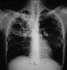 Scenario A patient with pan-susceptible pulmonary TB is started on