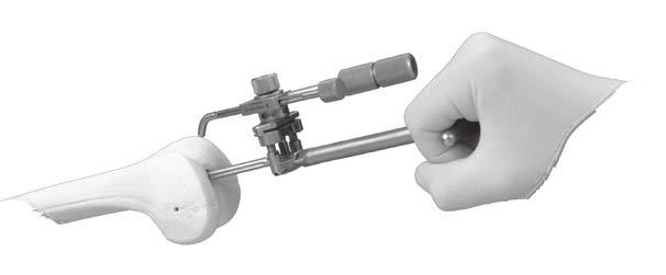 7) or with the Inserter/Extractor handle (Fig. 8). TECHNIQUE TIP 4.