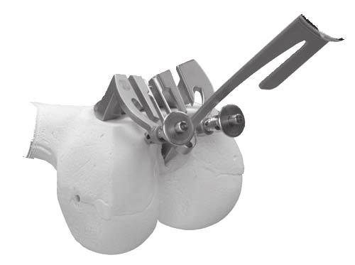 - Intercondylar Notch Clearance: Ensure the implant will not overhang into the intercondylar notch.