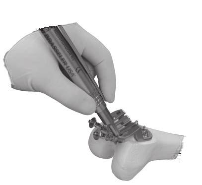D If the Milling Handpiece appears to "stick" in area near feet, make sure foot is fully raised.