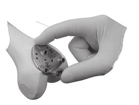 - The Peg/Tail Guides match the outside geometry and inlayed thickness of the trochlear implant.