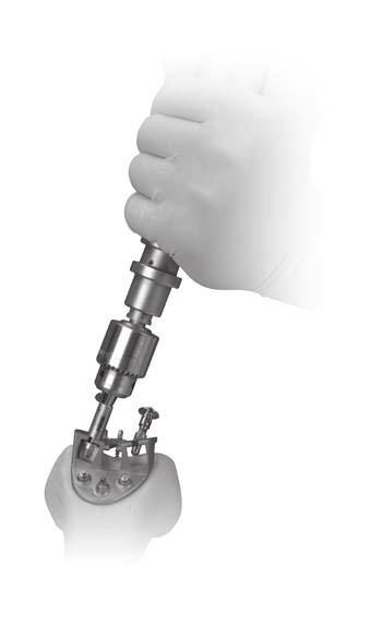 Perform the Backup Milling Operation: Refer to section 6 in the Gender Solutions Patello-Femoral Joint System surgical technique for order of track milling and feet positions with the following