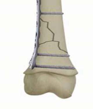 This stable fixation encourages direct bone healing rather than relying upon callus formation to achieve early stability. can be inserted sub-muscularly thus avoiding periosteal stripping.