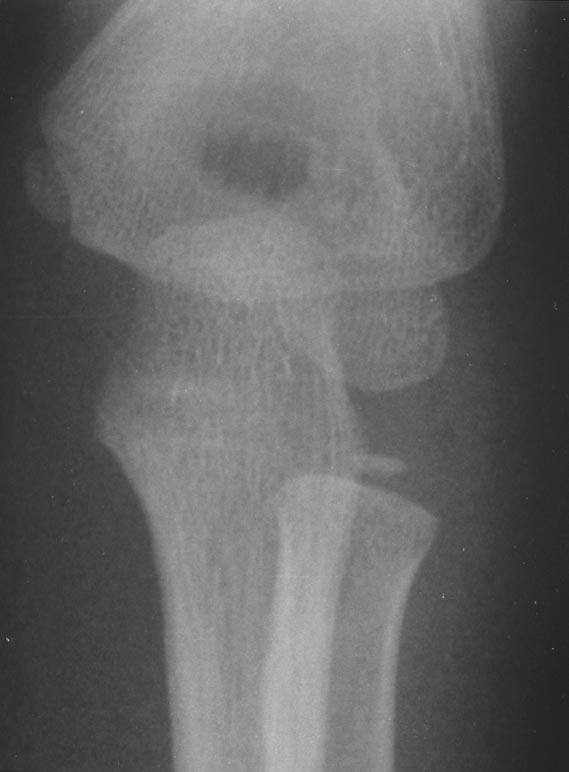 Of the pediatric patients, two showed Salter-Harris Type III fractures of the epicondyle; one, Salter-Harris Type I fracture of the medial epicondyle (Fig. 1); one, radial head fracture (Fig.