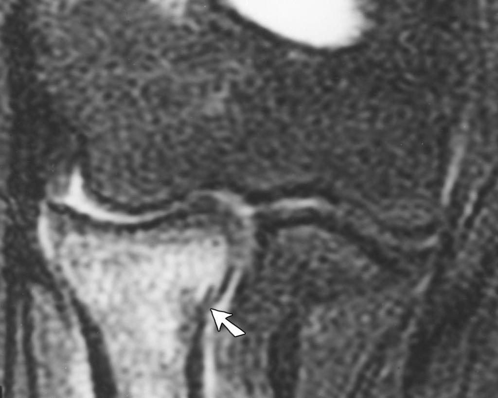 Therefore, 57% of the pediatric patients studied had a fracture that was only seen as an effusion on the initial radiographs. ut all (100%) had a detectable injury as evidenced by bone marrow edema.
