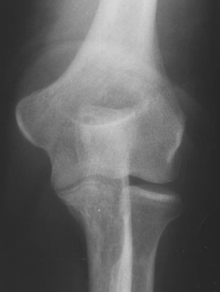 Indeed, all of the imaged patients had intraarticular injury, which confirms the traditional teaching that occult fractures or injuries are present.