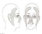 Mohs Surgery BCCA High risk anatomic locations High risk areas H zone nasal ala, nasal septum,