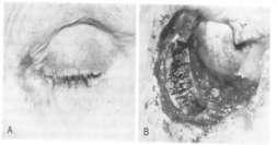 and brain invasion Eyelid extend along conjuctival surface of Tarsal plate Aggressive BCCA