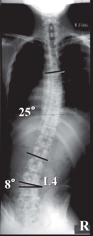 74 T. Koakutsu et al. A B C Figure 2. Preoperative plain X-rays.