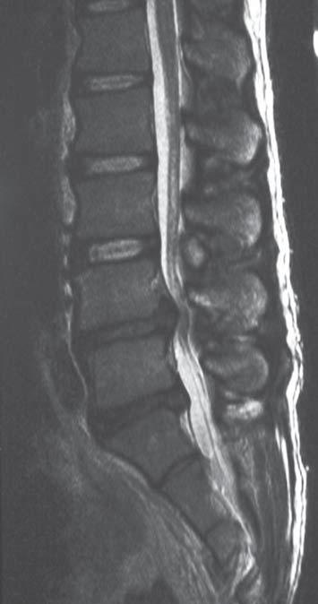 Bilateral spondylolysis of inferior articular processes 75 Figure 3. MR images of the lumbar spine revealed spinal canal stenosis at L4/5 (T2-weighted image, sagittal section).
