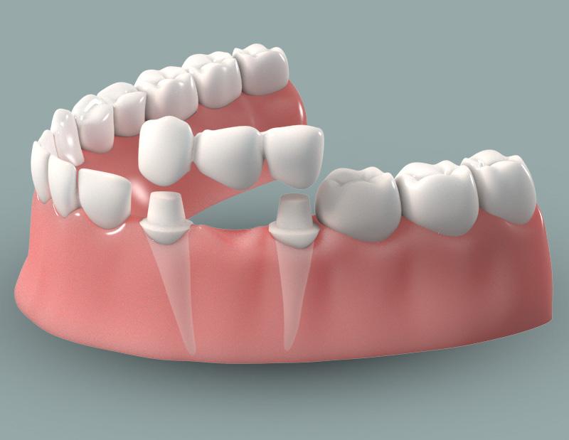 Fill the gap without sacrificing two adjacent teeth Traditional bridge