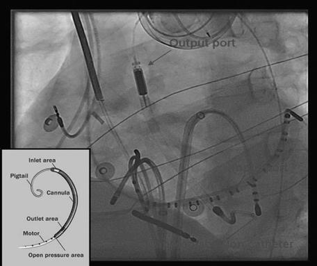 Impella device and VT