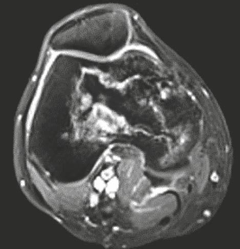 MRI. An infarct usually has a well-defined, densely
