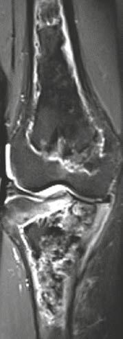 Fat in the lesion as seen in 12C, E and G (yellow