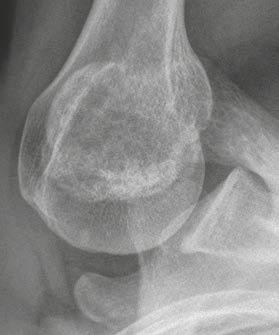 Clinical Orthopedic Imaging Chondroid type Osteochondroma (Fig. 13) A synonym for osteochondroma is cartilaginous exostosis.