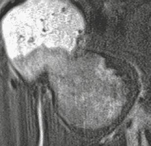 shoulder, (13C) sagittal T2w MRI shows another part of the osteochondroma with its cartilage cap, where the cap seems to be much larger than 8 mm, see