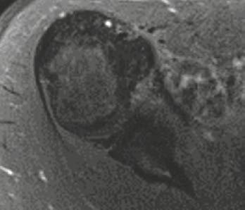 MRI shows the cartilage cap that is hypointense in T1w, (13F) axial contrast-enhanced T1w MRI with fat saturation show the same part of figure 13C with