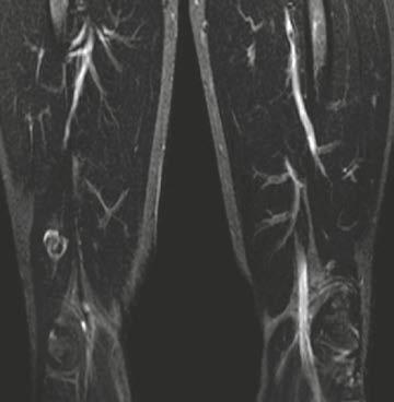 axial T2w MRI with fat saturation of the left humerus, (14D) sagittal T2w MRI with fat saturation of the left