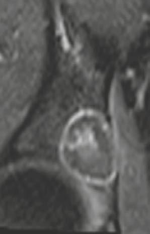 MRI: soft tissue mass or edema.