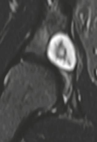 sharp border but without sclerotic rim according to a Lodwick IB lesion (orange arrow), in the center there is some flocculent