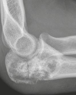 16A shows an antero-posterior radiograph of the left olecranon with a Lodwick