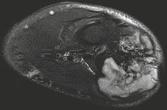 (16D) Coronal STIR MR image clearly shows the muscle edema (orange arrow).