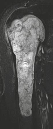 chondrosarcoma of the right humerus.