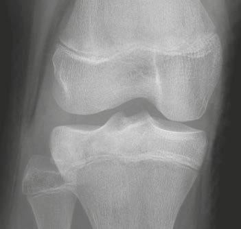 Clinical Orthopedic Imaging Chondroblastoma (Fig. 18) Patients are usually younger than 20 years (i. e. skeletally immature patients).