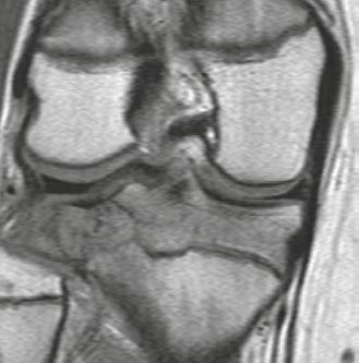 This entity also occurs in carpal and tarsal bones and rarely in the patella (which with regard to the differential diagnosis of lytic lesions