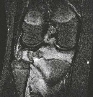 (18C) Coronal and (18D) sagittal T1-weighted MR images show the bordered lesion having a discreet hypointense sclerotic rim and a central