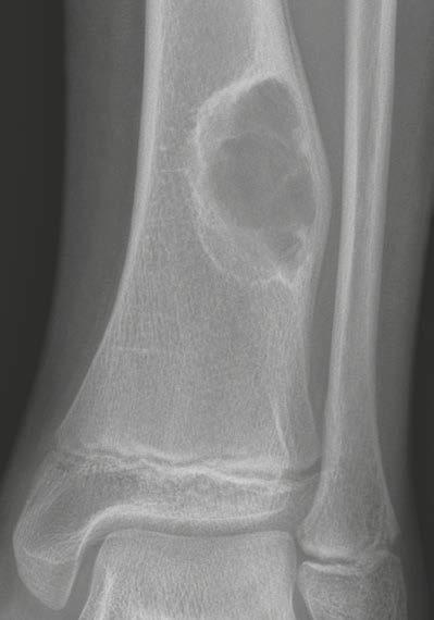 Orthopedic Imaging Clinical Fibrous type Non-ossifying fibroma NOF (Figs. 19 and 20) Patients are usually younger than 20 years and have no pain or periosteal reaction.